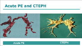 CTEPH comments and proposals - I. Lang